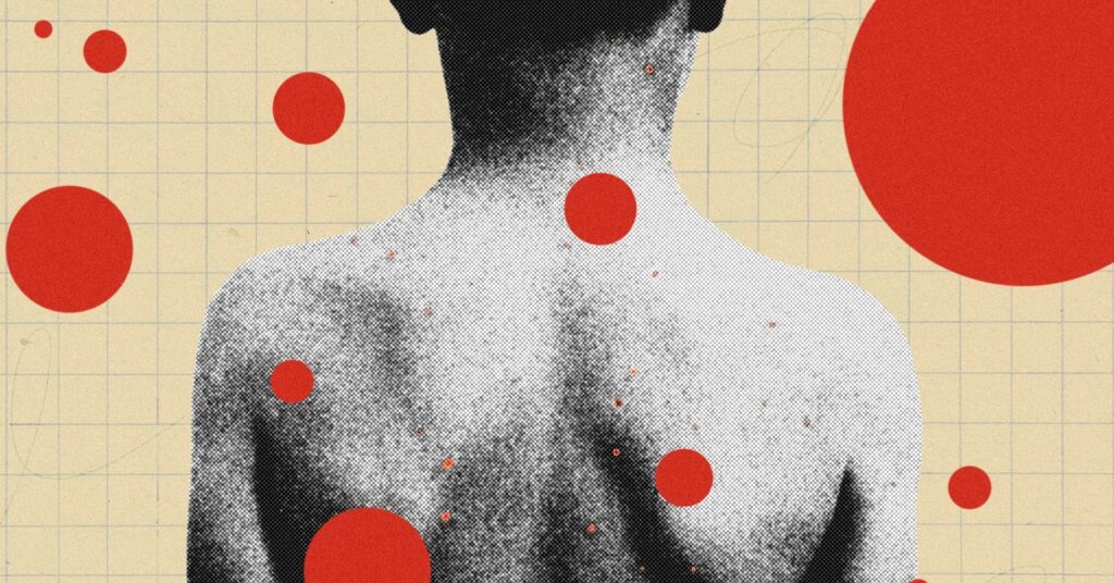 shingles series chickenpox parties science.jpg
