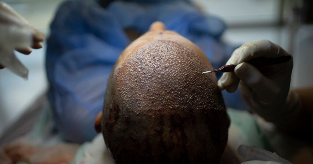 How Turkey Hacked the Hair Transplant Trade gettyimages 1280800924.jpg